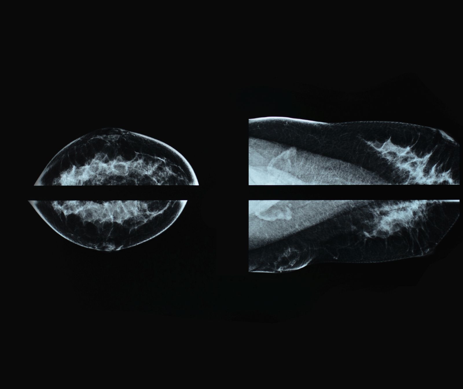 Mammography xray film image for breast cancer